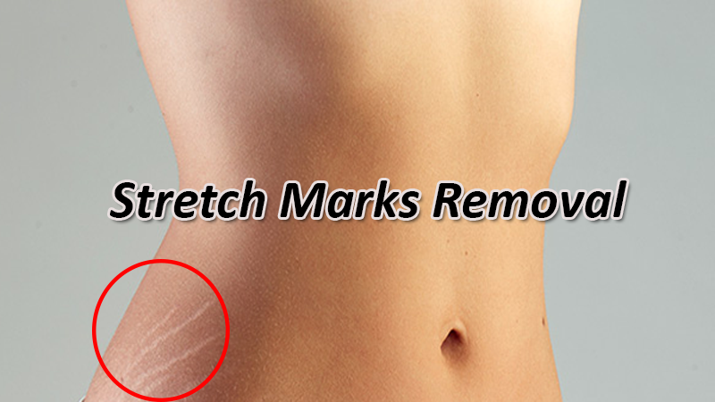 stretch marks removal